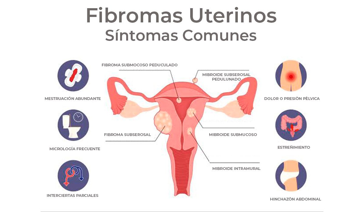 ¿Qué son los fibromas uterinos y cómo tratarlos sin cirugía?